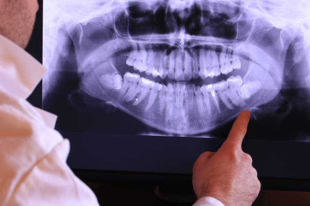 Best Emergency Root Canal Treatment in Morrow, OH